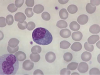 Rare type of blood cancer-Plasma cell leukemia